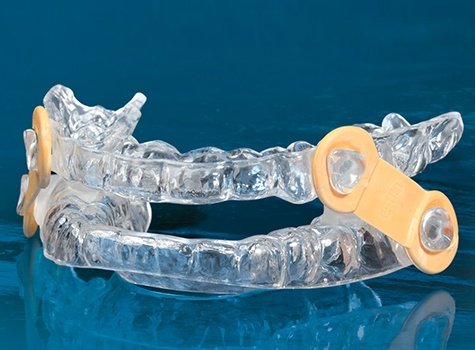 Elastic Mandibular Advancement device